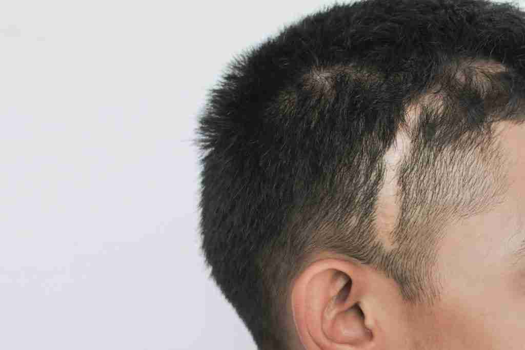 Scars,On,The,Head,,Scars,Caused,By,An,Accident