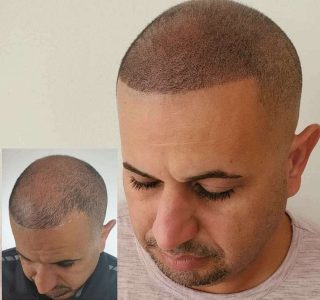 scalp-small-24